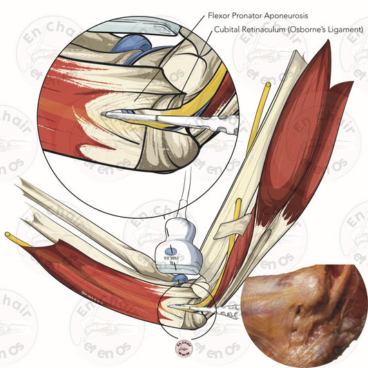 illustration anatomique chirurgie du bras